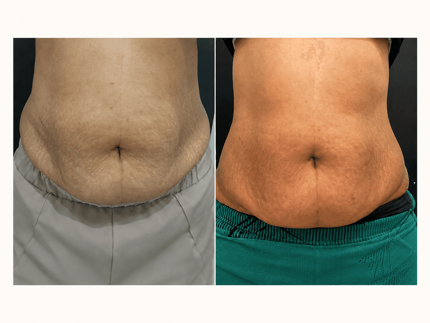 Body Contouring