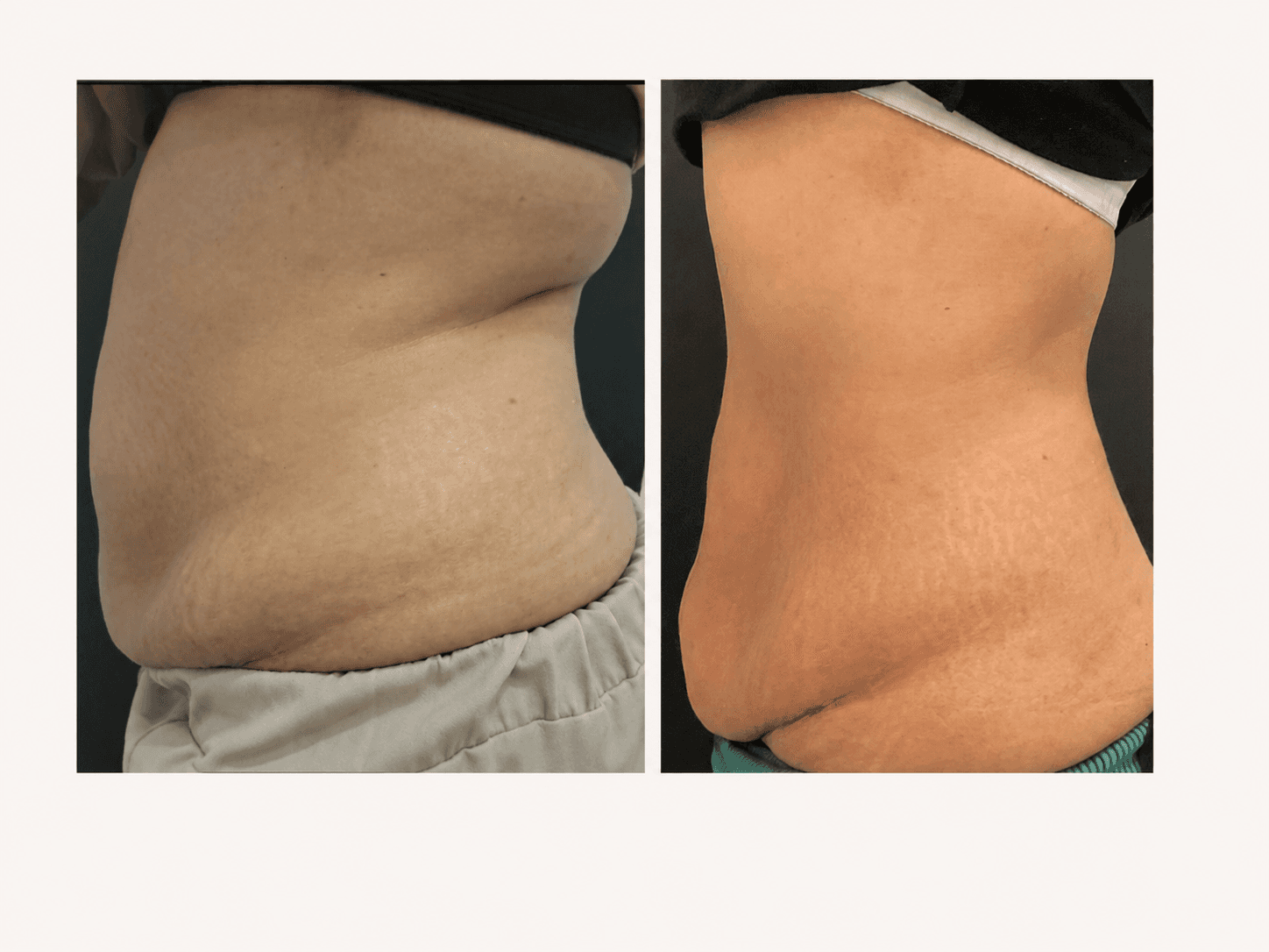 Body Contouring