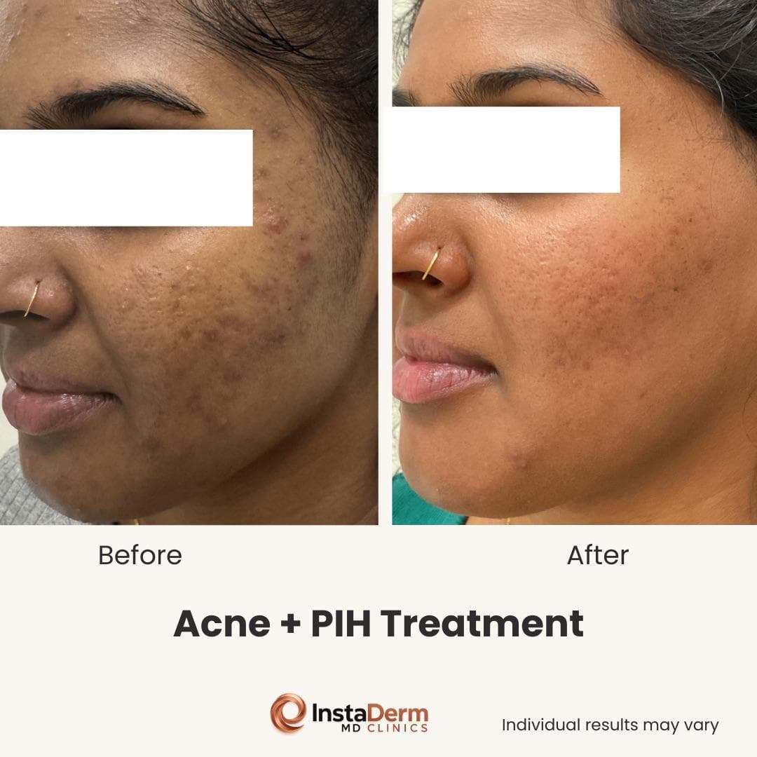 Laser Skin Rejuvenation