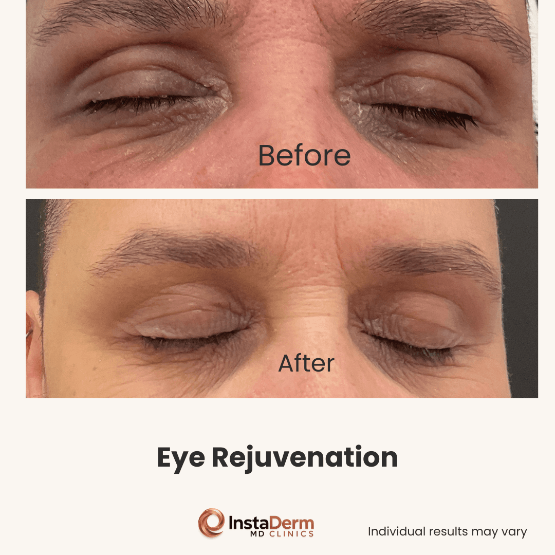 Eye Rejuvenation