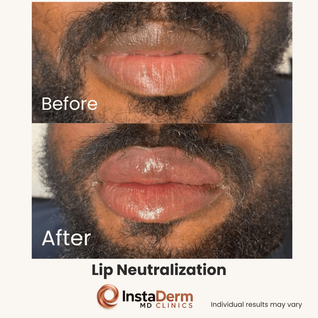 Lip Neutralisation