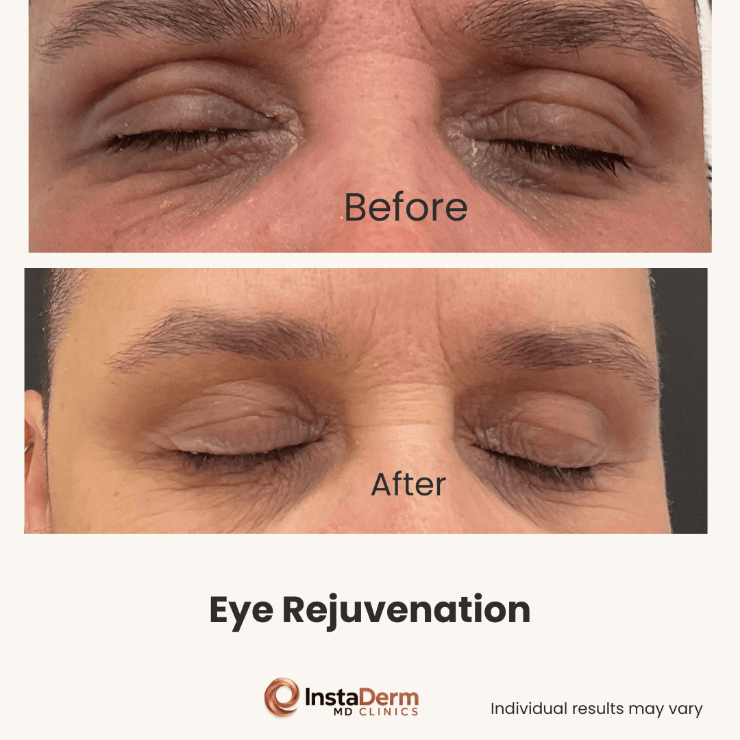 Eye Rejuvenation