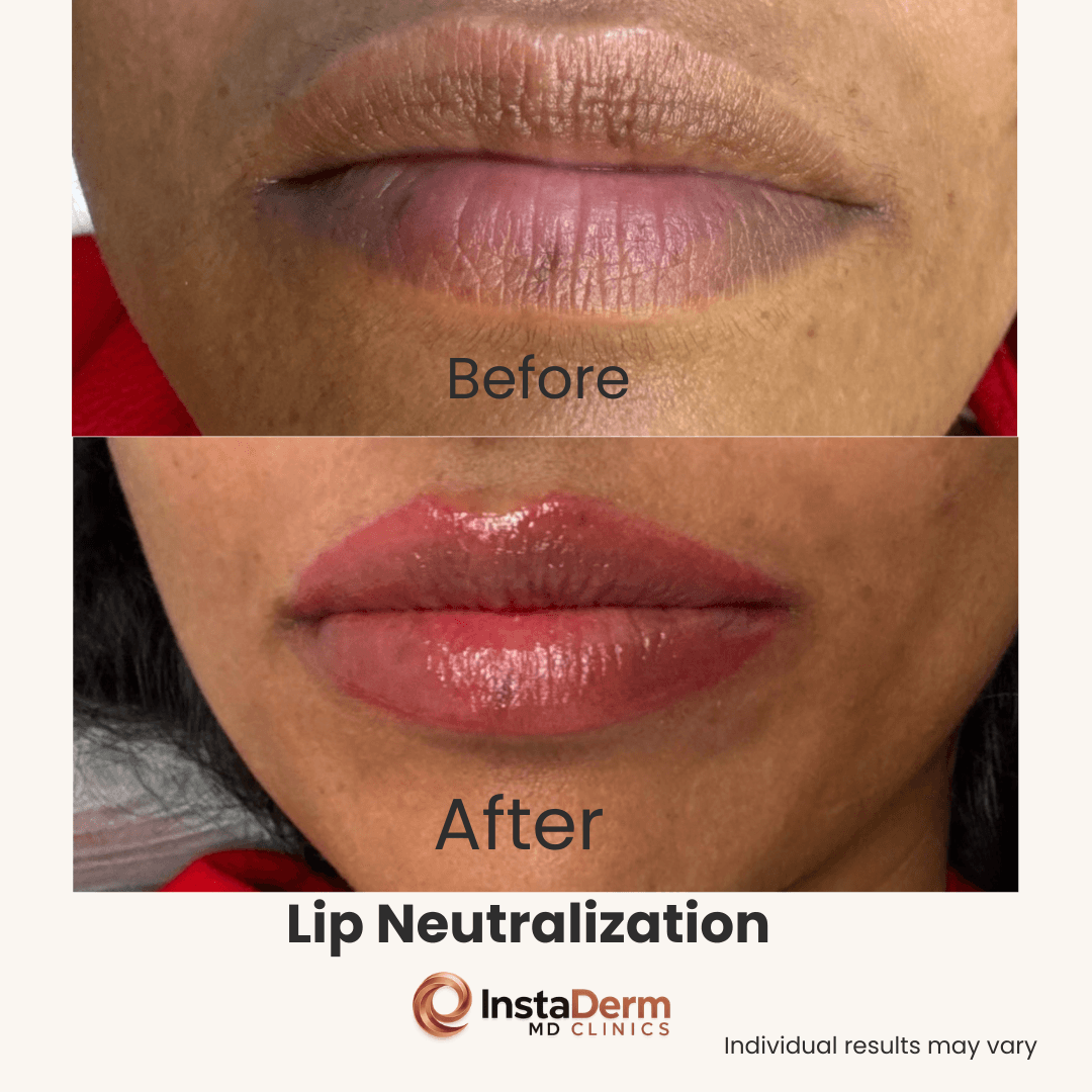 Lip Blushing
