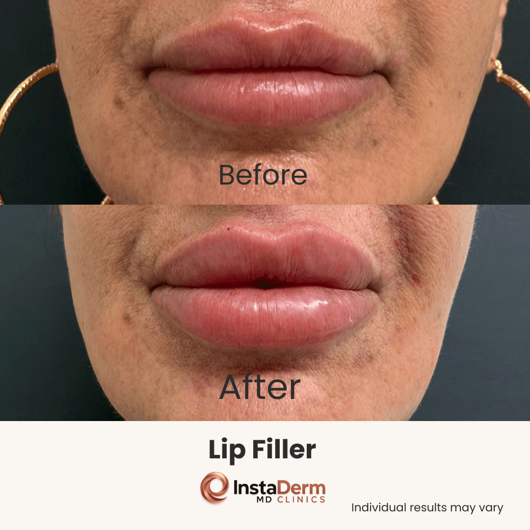 Lip Filler